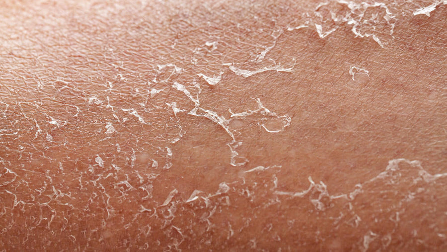 A close-up of severely dry and flaking skin representing one of the later stage signs you're not eating enough protein when the body pulls resources away from skin tissue over time.